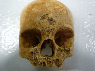 Illustration for article titled Finally, a Digital Library of Bizarre Human Bones From the Middle Ages